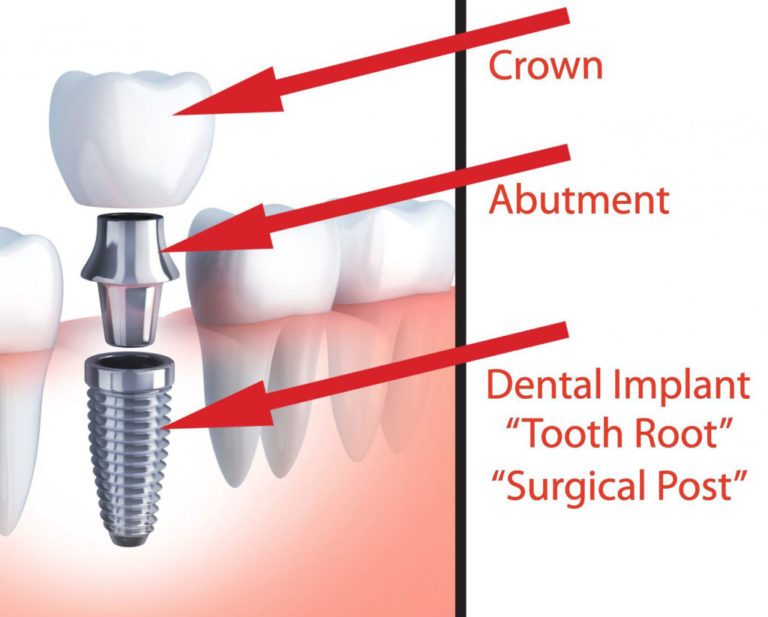 Struggling With Osteoporosis And Denied Dental Implants? | The Facial ...